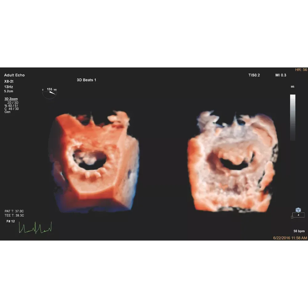 Philips EPIQ CVx ультразвуковой аппарат
