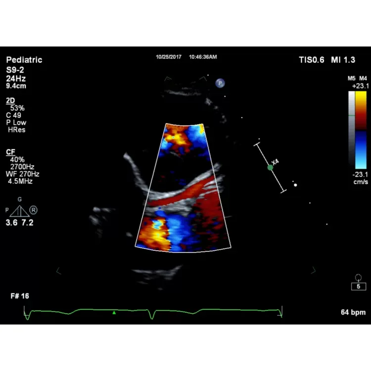 Philips EPIQ CVx ультразвуковой аппарат