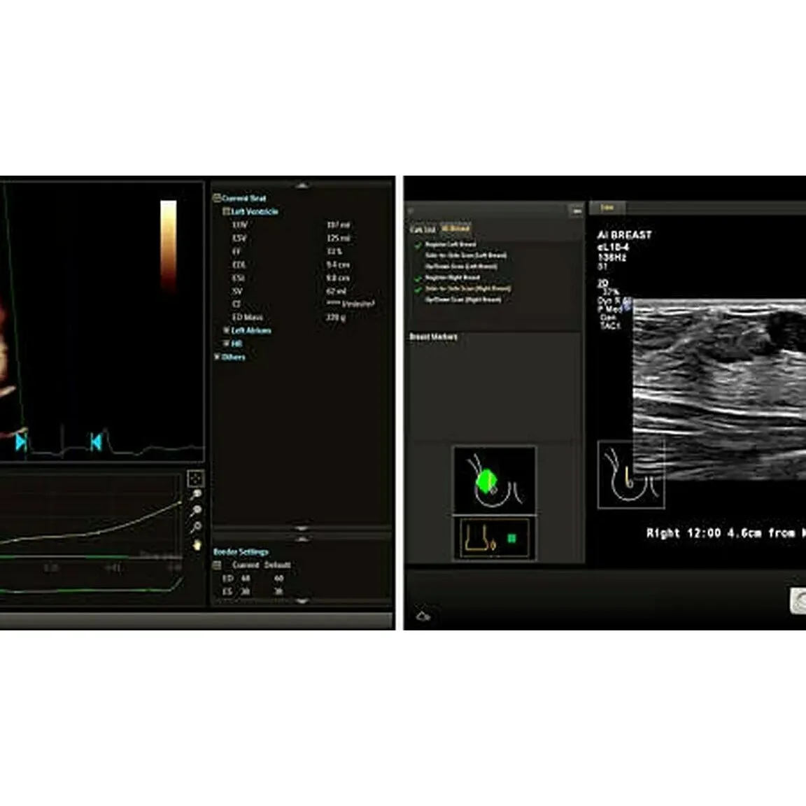 Philips EPIQ Elite ультразвуковой аппарат