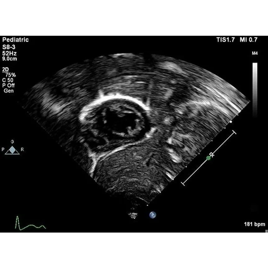 Philips EPIQ Elite ультразвуковой аппарат Philips EPIQ Elite ультразвуковой аппарат